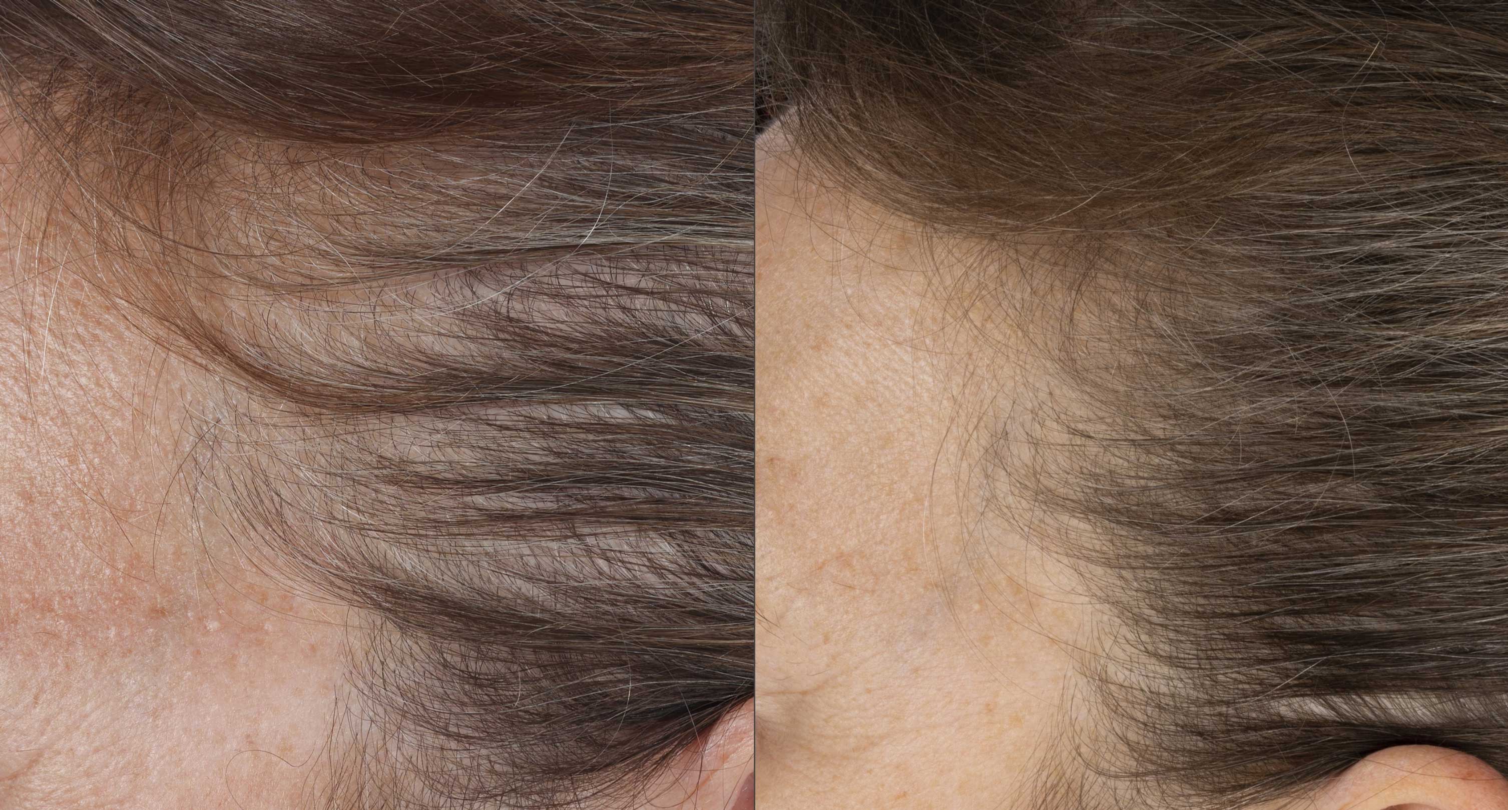 Close up of before and after image of brown haired woman with thin hair and hair growth results over 16 weeks. 