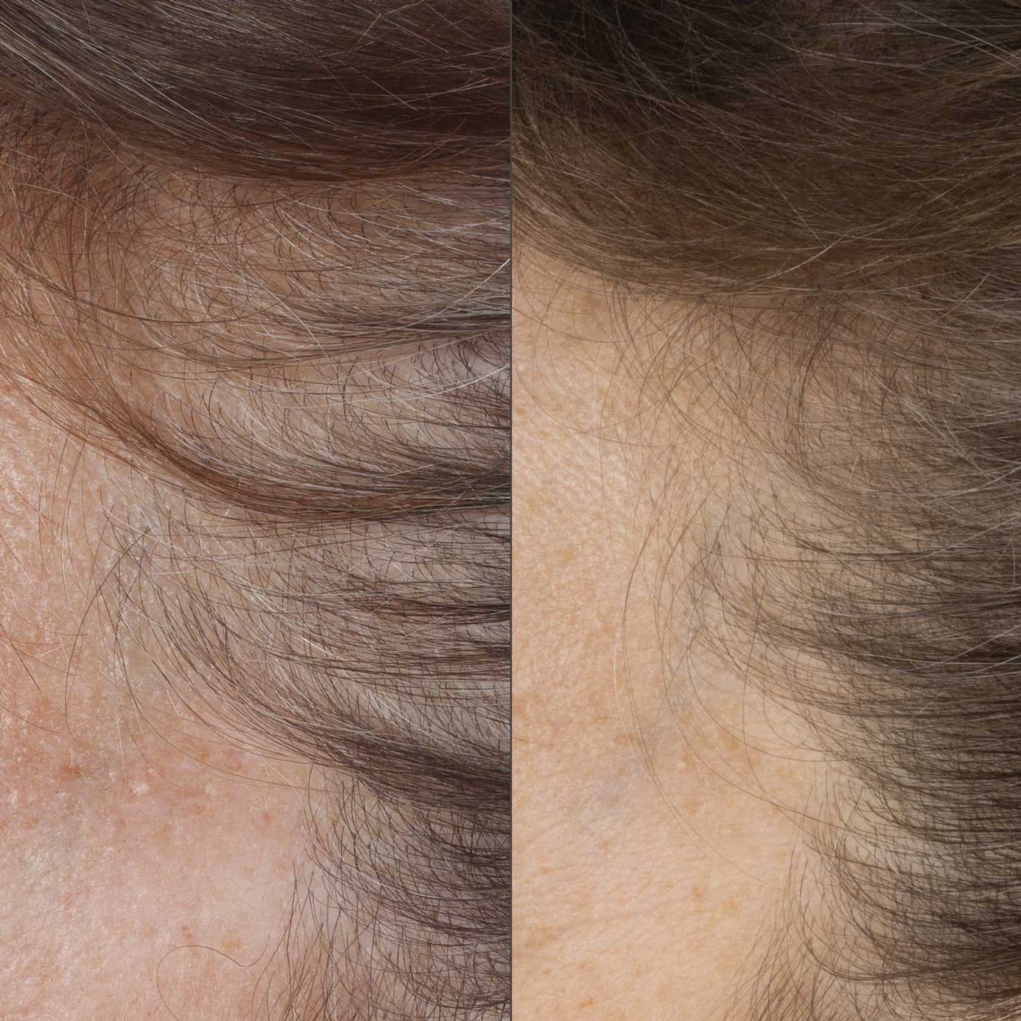 Close up of before and after image of brown haired woman with thin hair and hair growth results over 16 weeks. 